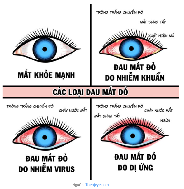 image_1-1 đau mắt đỏ